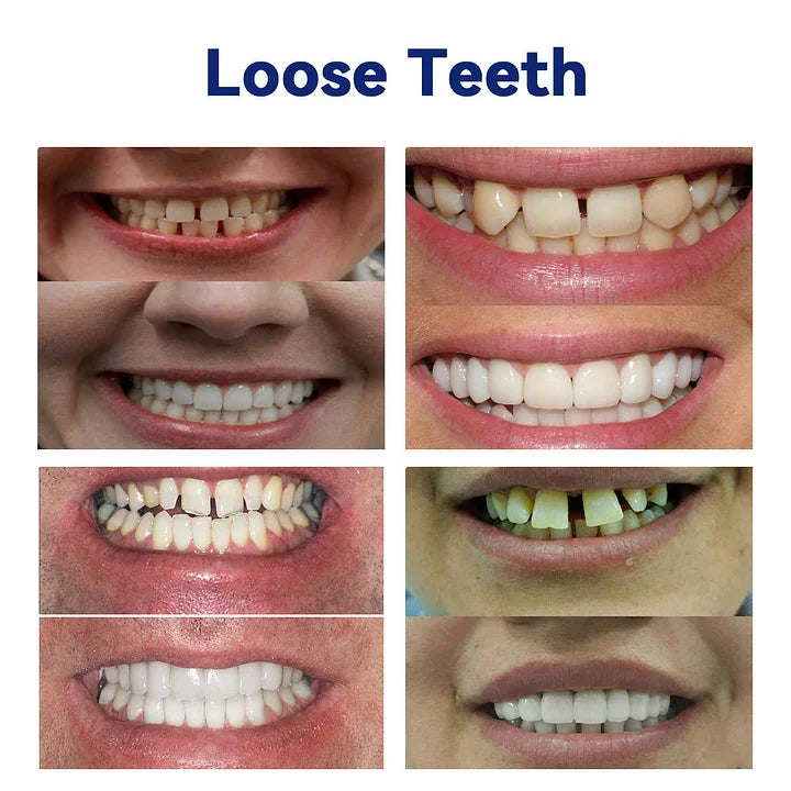 NESLEMYā¢-š¦·Advanced Customized Full Denture Set𦷠(ā°Limited time discount last 30 minutesā°)