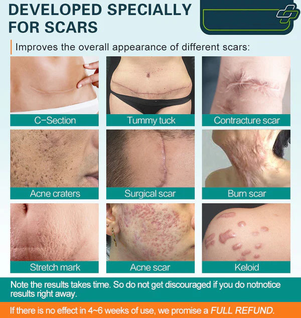HZA™❤️Advanced Scar Spray For All Types of Scars - For example Acne Scars, Surgical Scars and Stretch Marks ⚡️⚡️⚡️