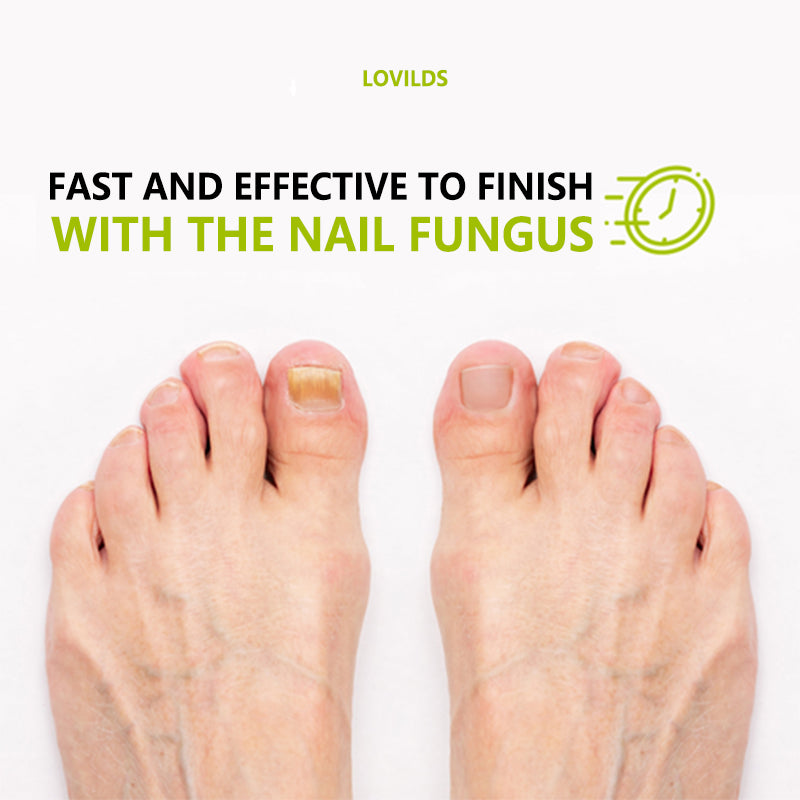 LOVILDS™ ELIMINA LOS HONGOS DE LAS UÑAS EN 5 DÍAS Y EVITA QUE APEREZCAN PARA SIEMPRE🔥55% Off for a Limited Time!